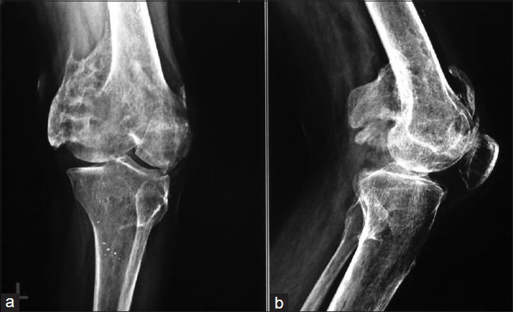 X-ray of left knee showing heterotopic ossification around knee joint: (a) AP view (b) Lateral view